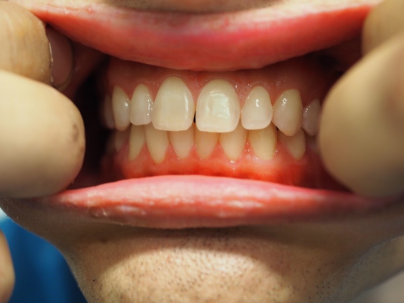 the pro 5000 removed all the visible plaque.