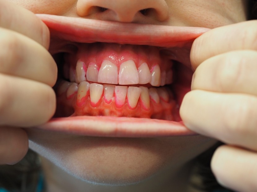 philips sonicare diamondclean - the accumulated plaque dyed pink prior to the cleaning test with the...