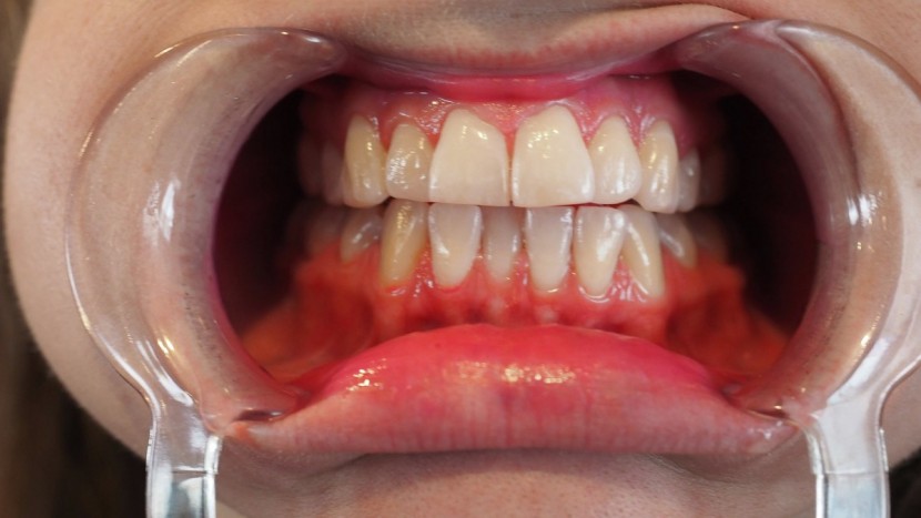 oral-b genius x - no visible plaque, which is a win for this device.