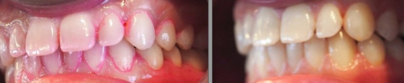 oral-b genius pro 8000 - the pro 8000 removed almost all of the plaque in our cleaning test.