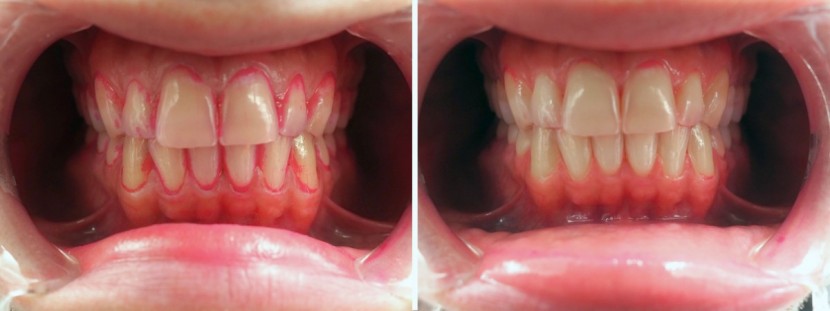 philips sonicare series 2 - the sonicare got most of the plaque off, but missed some in the hard...