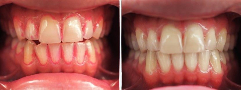 colgate smart electronic toothbrush e1 - the e1&#039;s before and after cleaning performance of incisors.