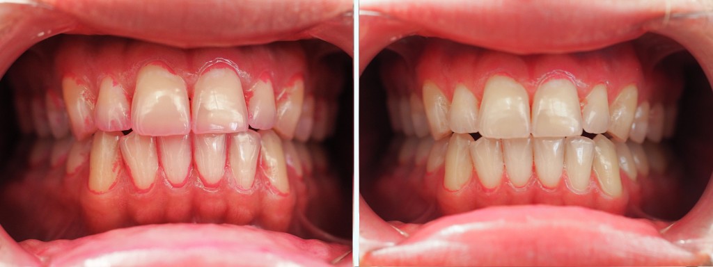 philips sonicare diamondclean smart 9500 - this toothbrush did quite well in our cleaning challenge.