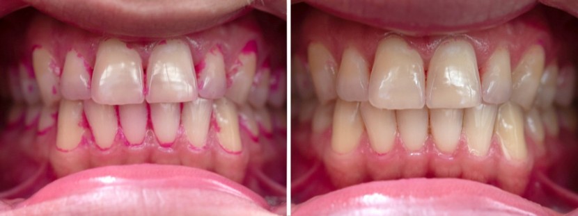 philips sonicare protectiveclean 6100 - the protectiveclean 6100 did well at removing plaque.