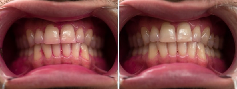 brio smartclean sonic - the sonicclean got most of the plaque but still missed a few spots.