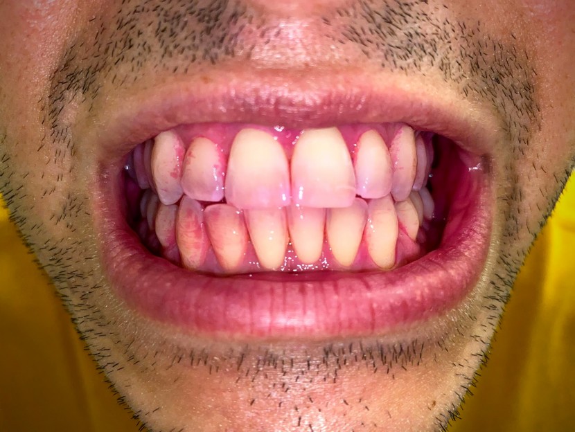before brushing, plaque is visible (in pink) on the teeth and around...