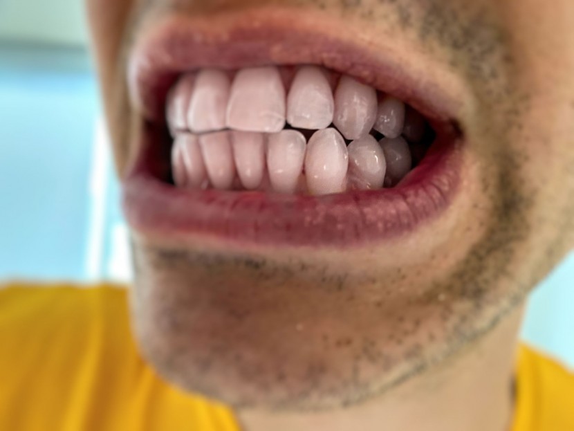 after rinsing, much of the visible plaque between the lower canine...