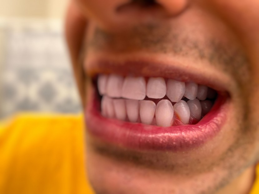 the disclosing tab highlights plaque between the lower canine and...