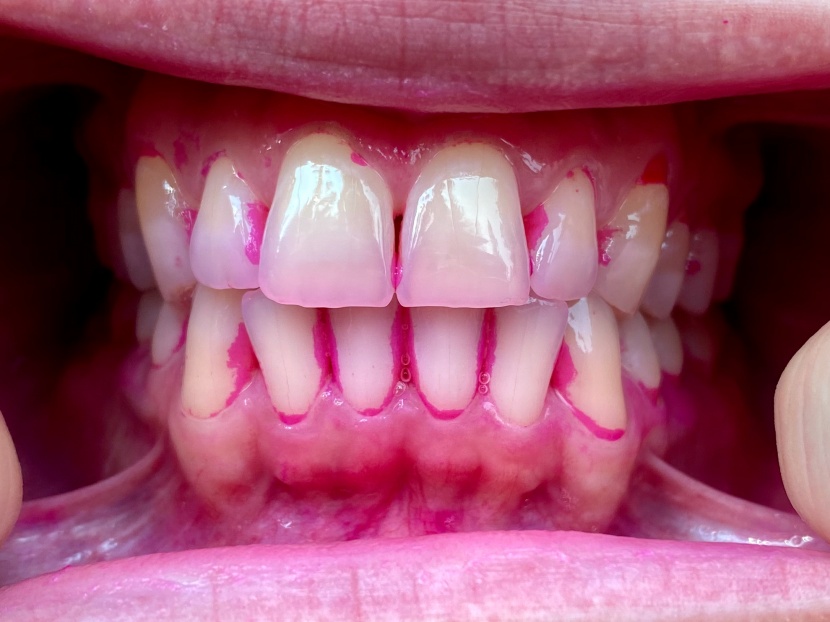 the plaque has been stained pink with a plaque-disclosing tablet.