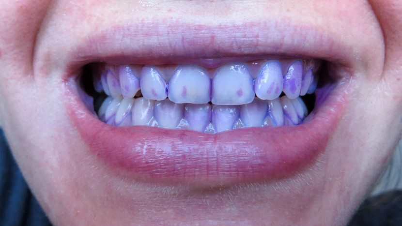 after not brushing for 18 hours, our judges used disclosing tablets...