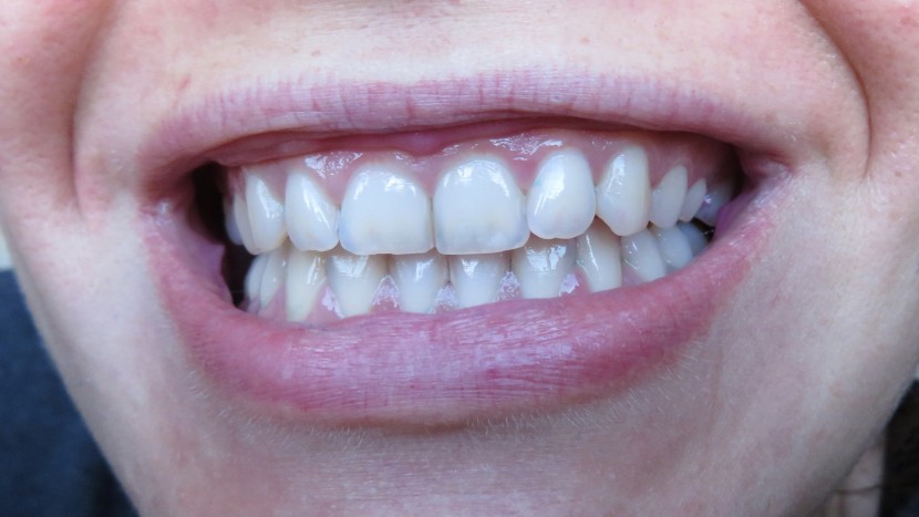 plaque removal after using the philips one.