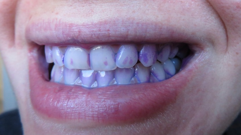 after not brushing for 16 hours, our judges used disclosing tablets...