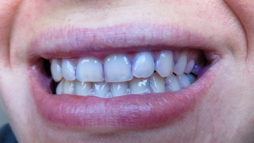 plenty of plaque was left behind after using the sensitive mode on...