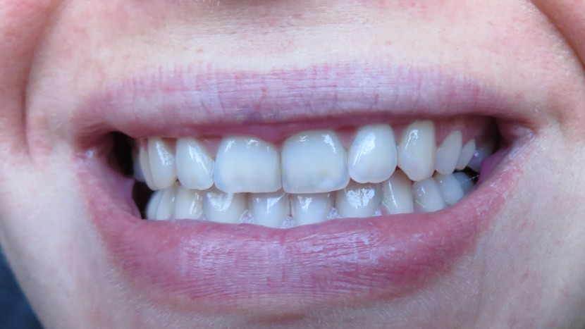 using the clean setting, most of the plaque was removed.