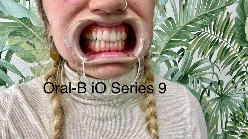 after brushing with the oral-b io series 9.