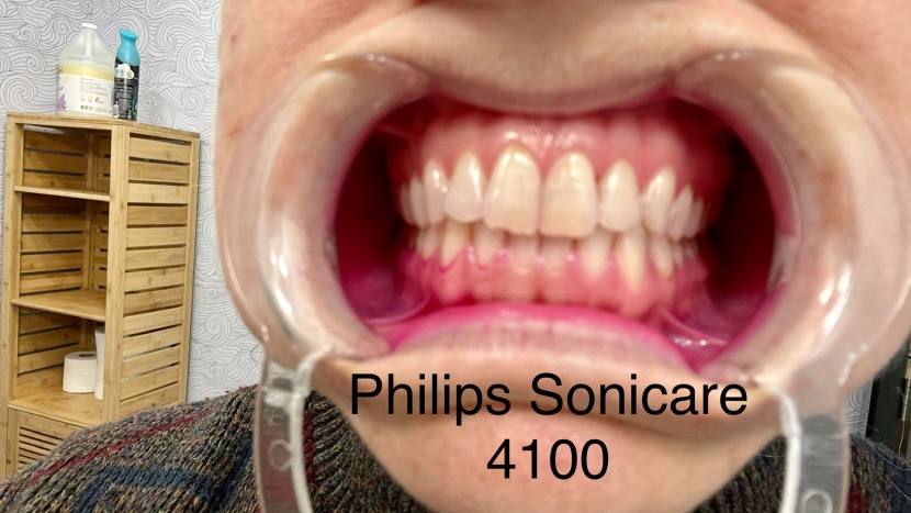 after cleaning with the philips sonicare 4100.